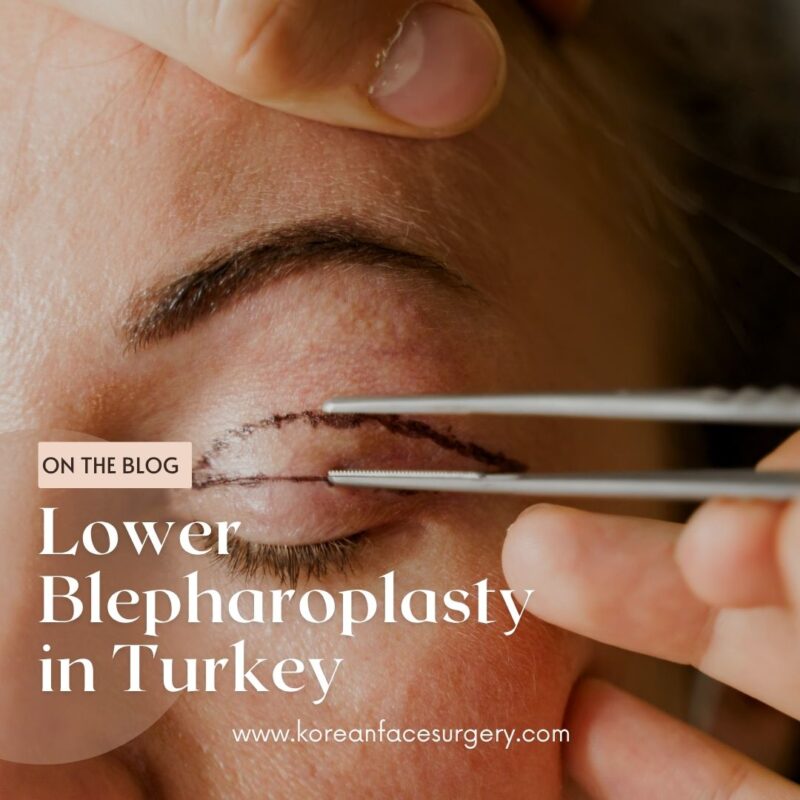 Lower Blepharoplasty Turkey